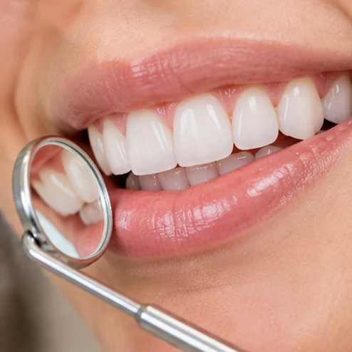 Illustrative Fillings dental image